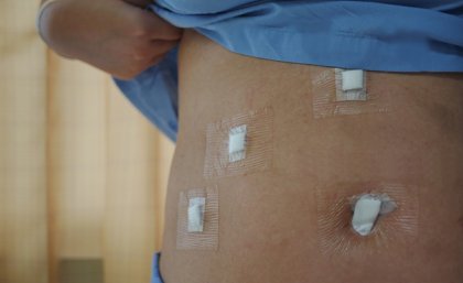 A woman lifts her shirt to show dressings from keyhole surgery on her abdomen.